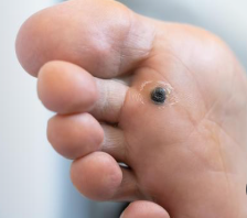 Fungal Infection in the foot