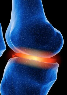 Knee Pain & Cartilage Degeneration