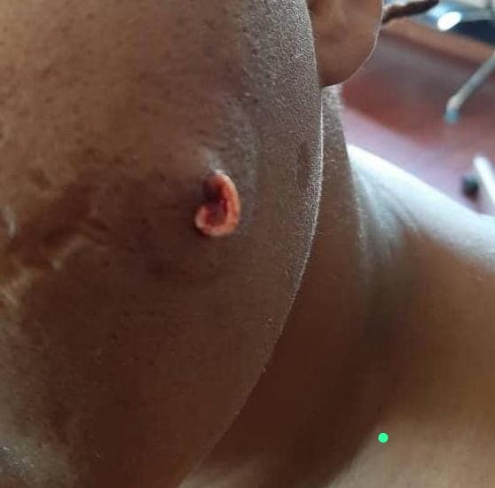 Acne - Stubborn deep facial pimple